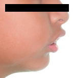 maloclusion-2