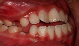 maloclusion-4