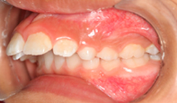 maloclusion-5