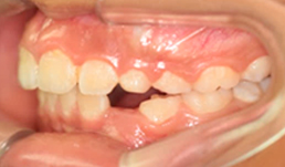 maloclusion-6